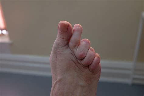 Why can't I bend my second toe?