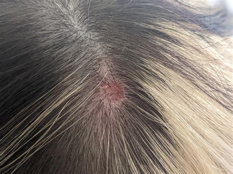 Why can't I stop picking at my scalp?