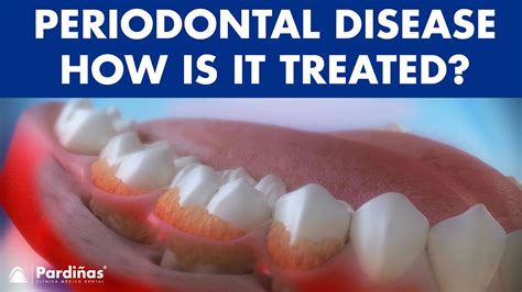 Why can't periodontitis be cured?
