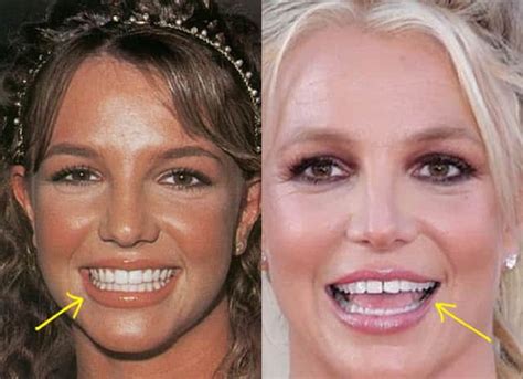 Why did Britney Spears teeth change?