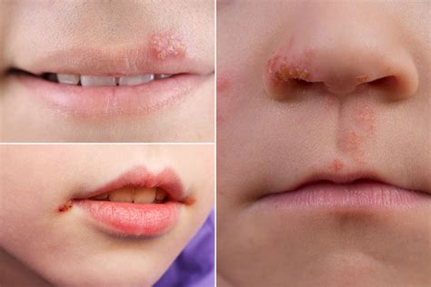 Why did I get cold sores as a child?