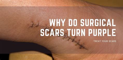 Why did my old scar turn purple?