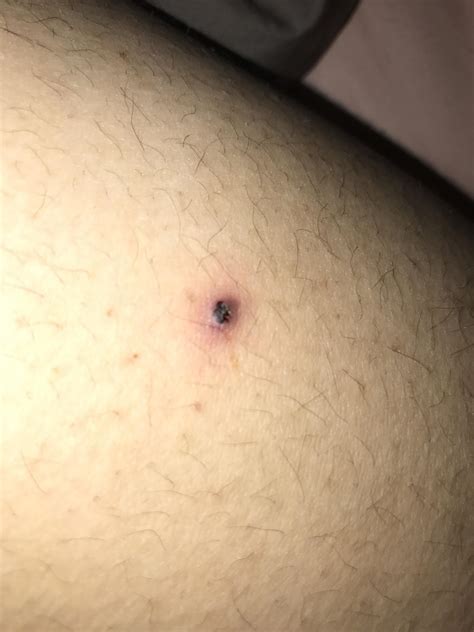 Why did my pimple turn black after I popped it?