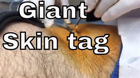 Why did my skin tag get bigger?