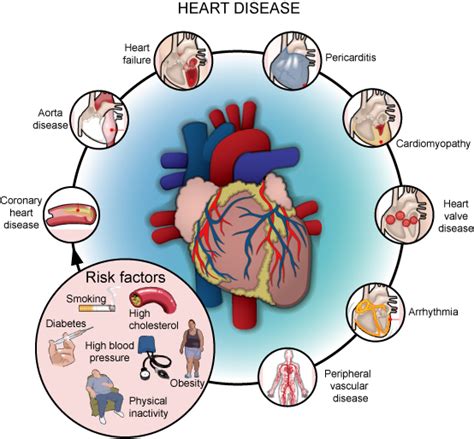 Why do French have less heart disease?