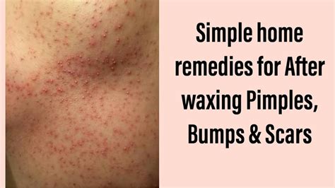 Why do I get bumps after Brazilian wax?