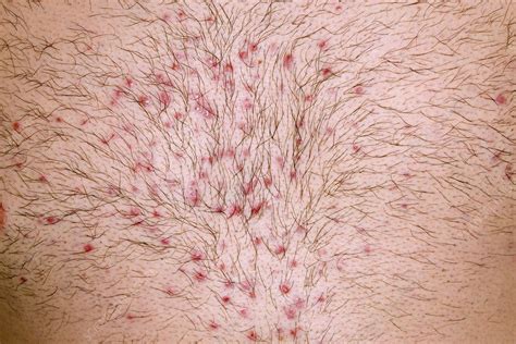 Why do I get folliculitis after waxing?