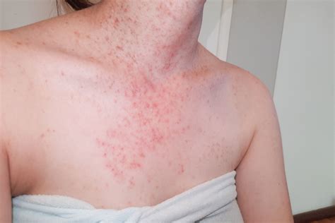 Why do I get folliculitis every time I wax?