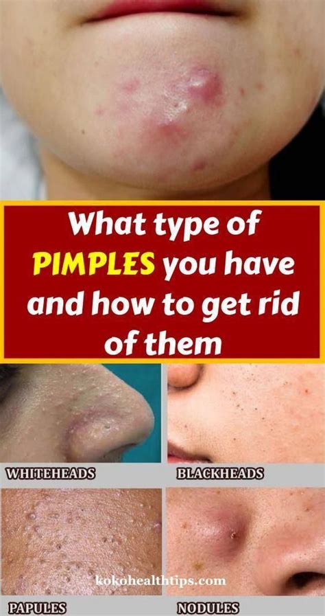 Why do I get pimples after steaming?