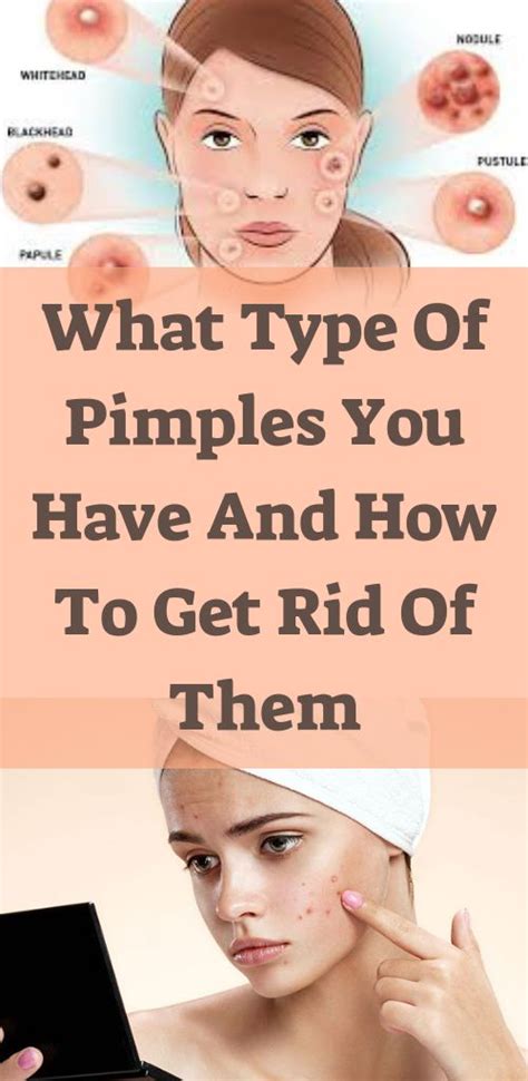 Why do I get pimples when I use moisturizer?