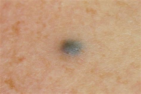 Why do I have a blue spot on my body?