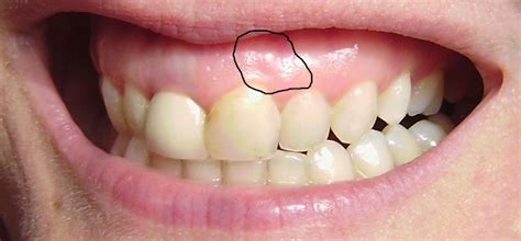 Why do I have a hard bony lump on my gum that doesn't hurt?
