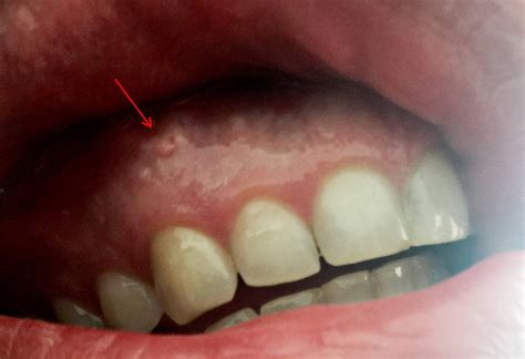 Why do I have a hard bump on the floor of my mouth?