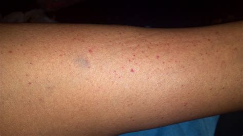 Why do I have a random blue mark on my leg?