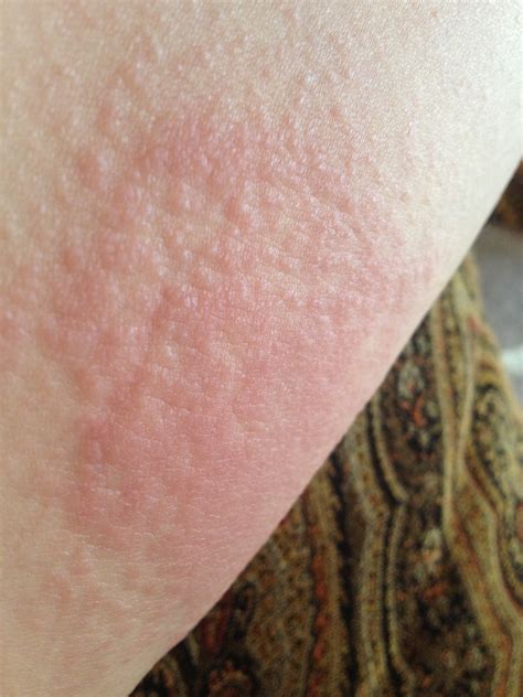 Why do I have a rash between my legs?