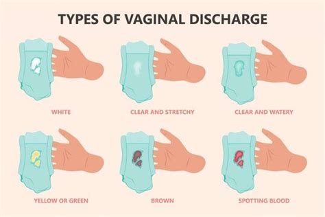 Why do I have discharge but no STD?