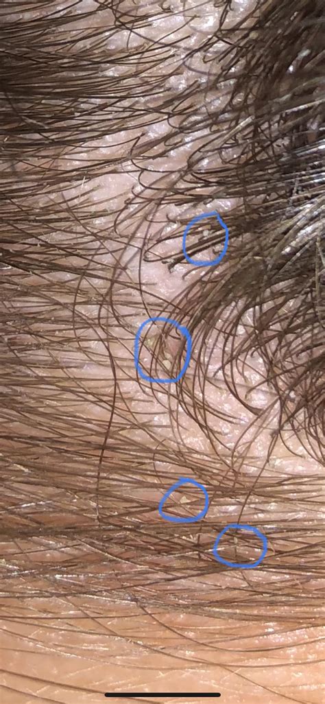 Why do I have little white balls on my scalp?