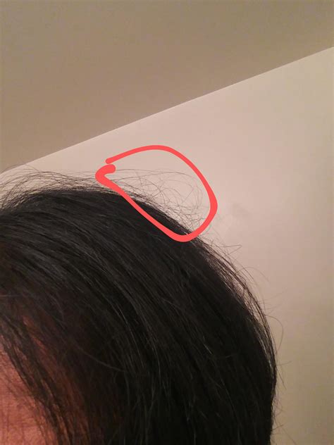 Why do I have one strand of white hair at 15?