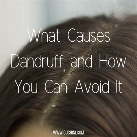 Why do I have so much dandruff?