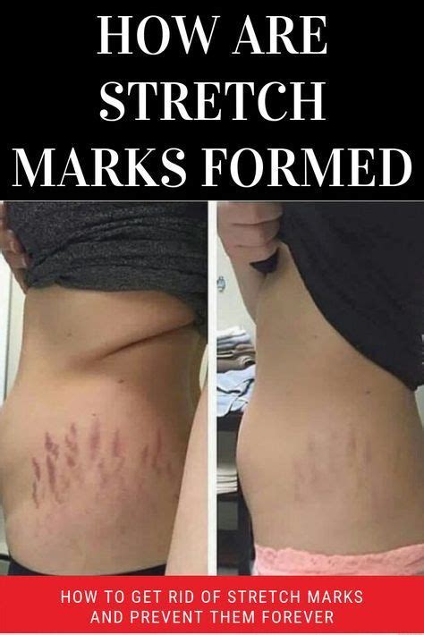 Why do I have stretch marks if I've always been skinny?