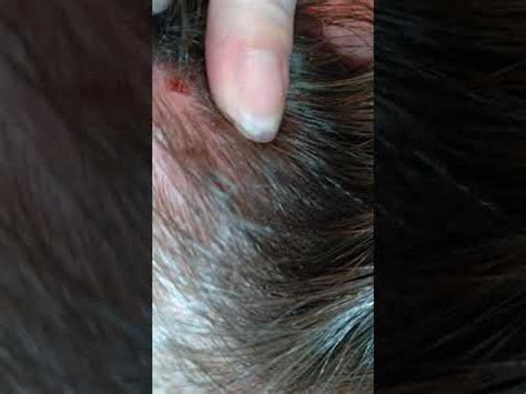 Why do I pick at my scalp until it bleeds?