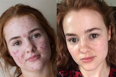 Why do I still have acne after 10 years?