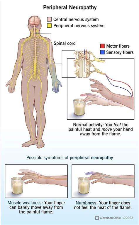 Why do I suddenly have peripheral neuropathy?