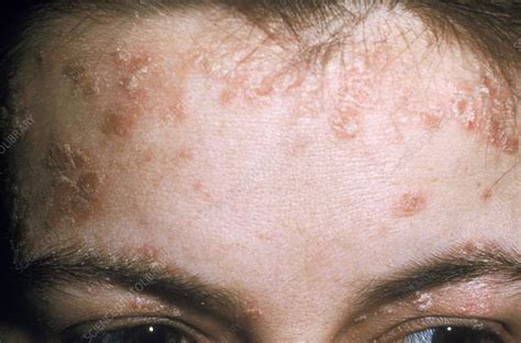 Why do I suddenly have seborrheic dermatitis?