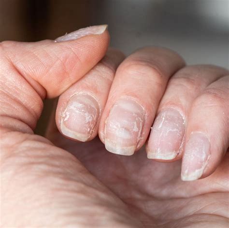 Why do acrylic nails peel off?