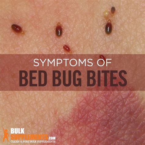 Why do bed bugs itch so much?