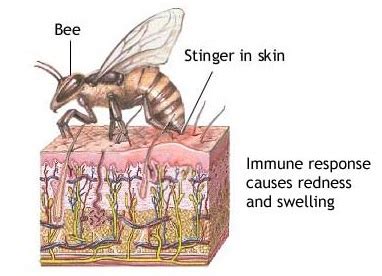 Why do bee stings hurt so badly?