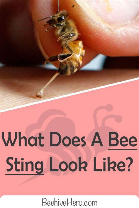 Why do bee stings itch?
