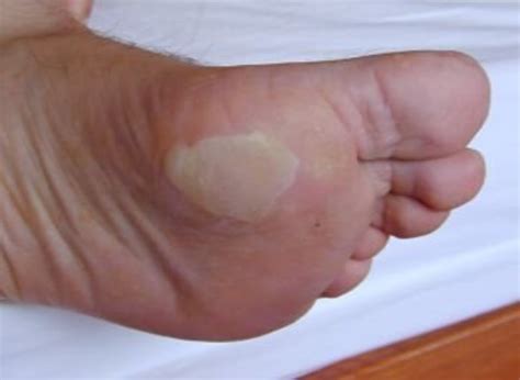 Why do blister patches turn white?