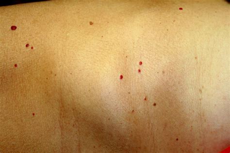 Why do blue spots appear on body without injury?