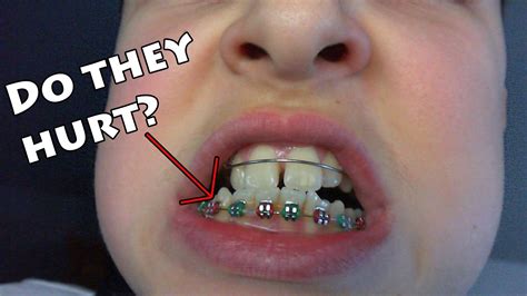 Why do braces hurt so much?