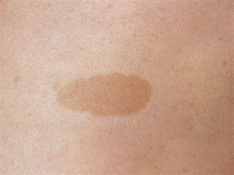 Why do brown birthmarks happen?