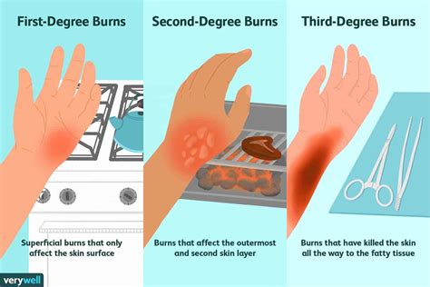 Why do burns hurt when exposed to air?