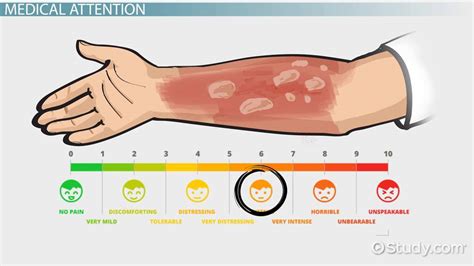 Why do burns stop hurting in water?