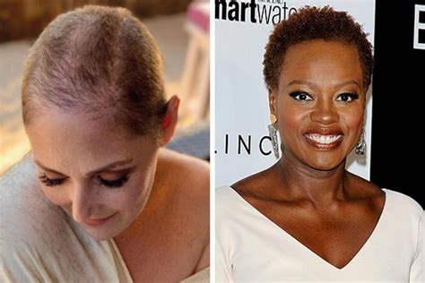 Why do celebrities not lose hair?