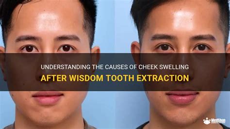 Why do cheeks get big after wisdom teeth?