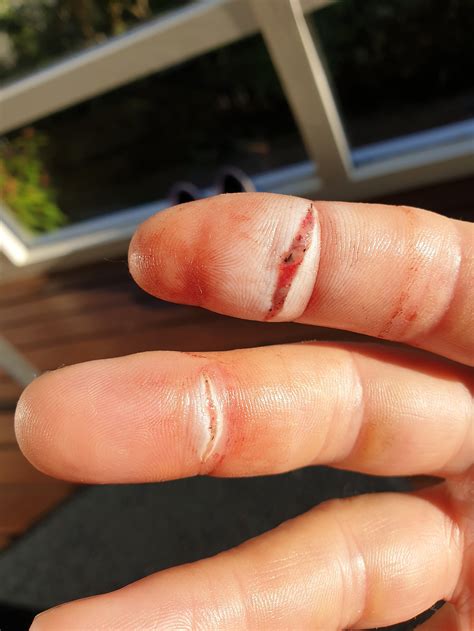 Why do fingers heal so fast?