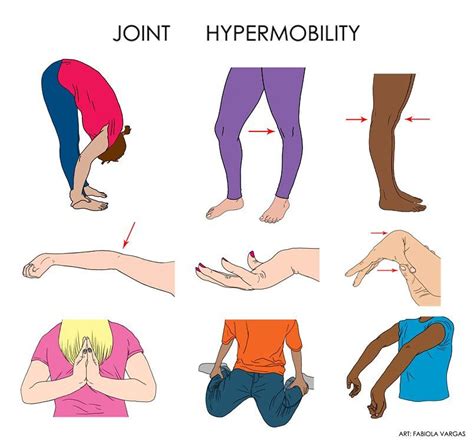 Why do hypermobile people have tight muscles?