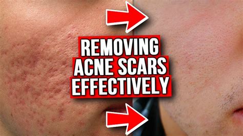Why do my acne scars never heal?
