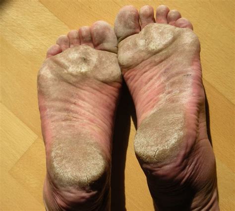 Why do my feet crack when I walk barefoot?