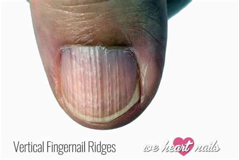 Why do my fingernails have ridges?