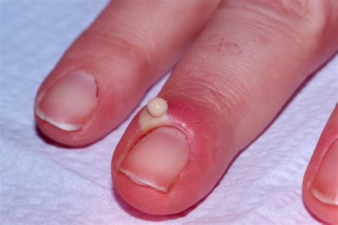Why do my nail tips hurt?