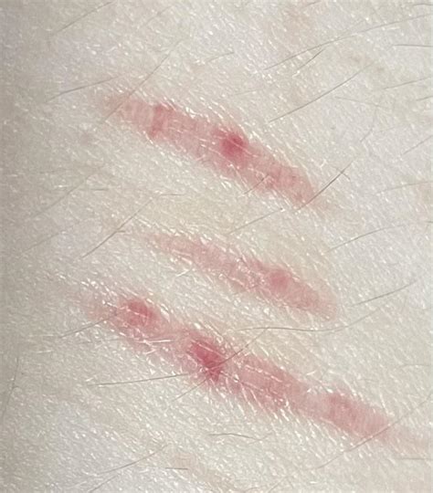 Why do my scars turn brown instead of white?