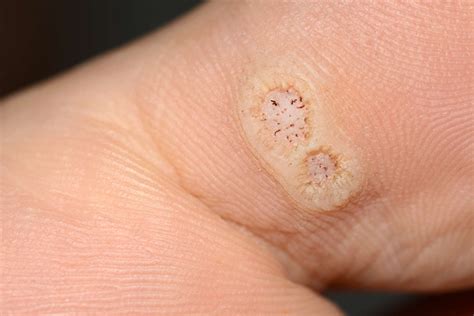 Why do my warts keep spreading?