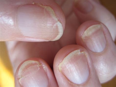 Why do nails split?