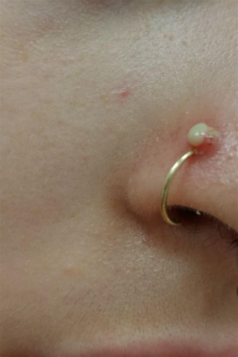 Why do old piercings fill with pus?